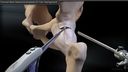 Femoral Neck Osteoplasty for Cam Lesion