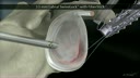 3.5 mm Labral SwiveLock® with FiberStick™